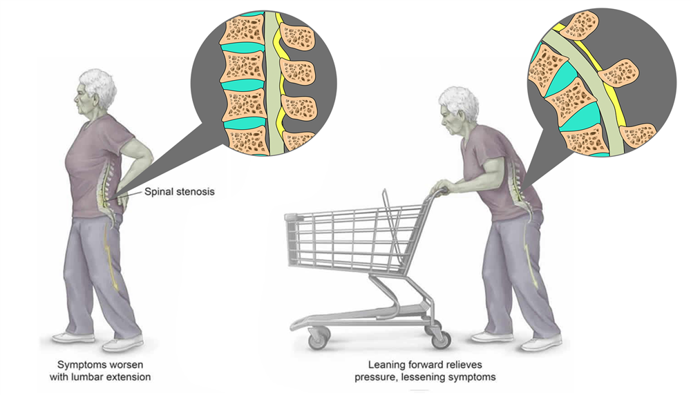 Spinal Stenosis